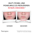 Anti Pickel+ Peeling Serum AHA/PHA/BHA Neutrogena