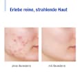 Gesichtscreme intens Aknederm