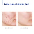 Tinktur Mein Teebaumöl Tiefenreinigend Aknederm