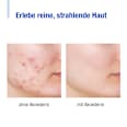 Reinigungsschaum gegen Hautunreinheiten Aknederm