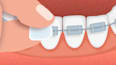 Ortho Wachs für Zahnspangen GUM