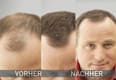 Streuhaar – Nr. 5 - 6 Medium Brown Cover Hair