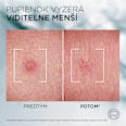 Pleťová pasta na akné Derma Control S.O.S. Pimple Paste  L'ORÉAL PARiS MEN EXPERT