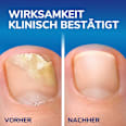 Nagelpilz Entferner Stift Scholl