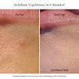 Anti-Pickel-Patches Sensitive Neutrogena