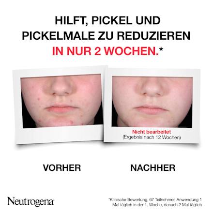 Anti Pickel Peeling Serum AHA/PHA/BHA Neutrogena