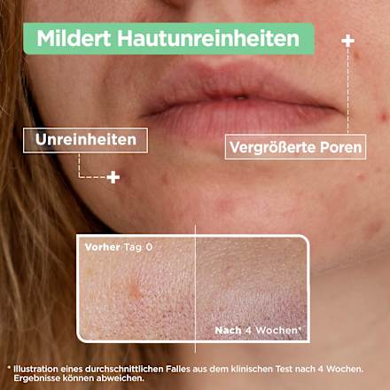 Serum Anti-Unreinheiten Mixa