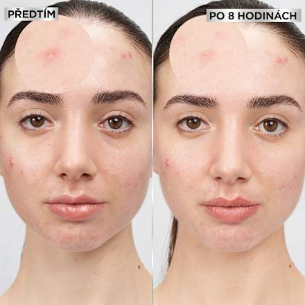 hydrokoloidní náplast na akné Invisible GARNIER PureActive
