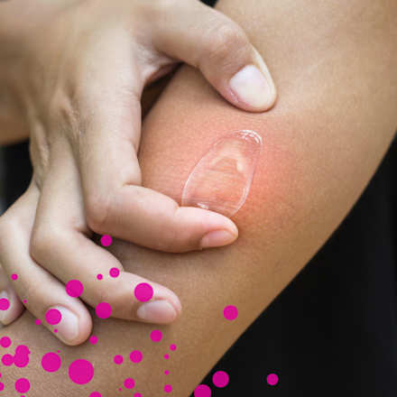 Insektenstichgel Soforthilfe  EMCUR