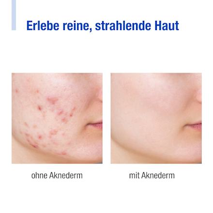 Gesichtscreme intens Aknederm
