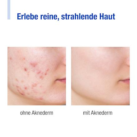 Reinigungsschaum gegen Hautunreinheiten Aknederm