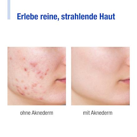 Feuchtigkeitscreme Lotion F Aknederm
