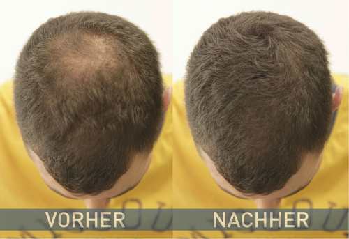 Streuhaar – Nr. 3 - 4 Dark Brown Cover Hair