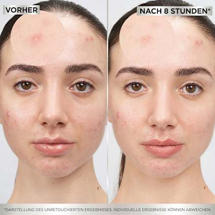 Anti Pickel Patches Invisible Garnier Skin Active