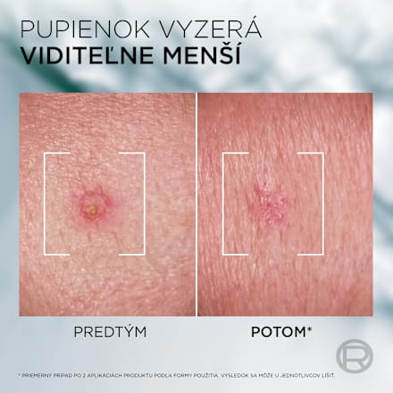 Pleťová pasta na akné Derma Control S.O.S. Pimple Paste  L'ORÉAL PARiS MEN EXPERT