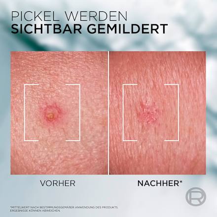 Anti Pickel Creme SOS Derma Control L'ORÉAL PARiS MEN EXPERT