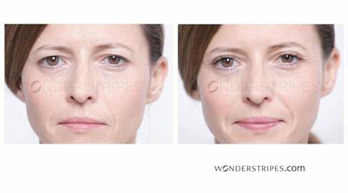 Kozmetički flasteri za optičku korekciju očnih kapaka WONDERSTRIPES