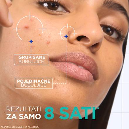 ANTI-PIMPLE pasta za lice Mixa