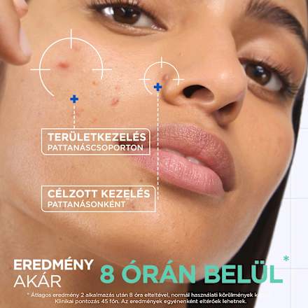 Koncentrált paszta pattanások ellen aknéra hajlamos bőrre Mixa