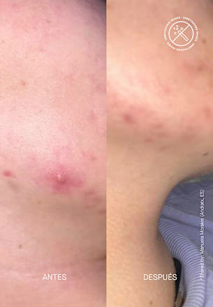 Anti Pickel Tagescreme Zitcontrol Acnemy