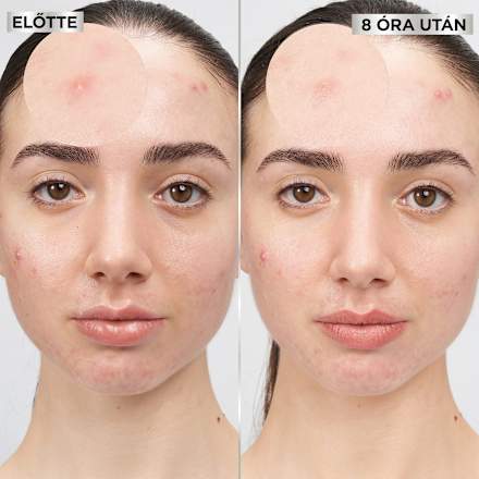 Pattanás tapasz Pimple Patch GARNIER PureActive