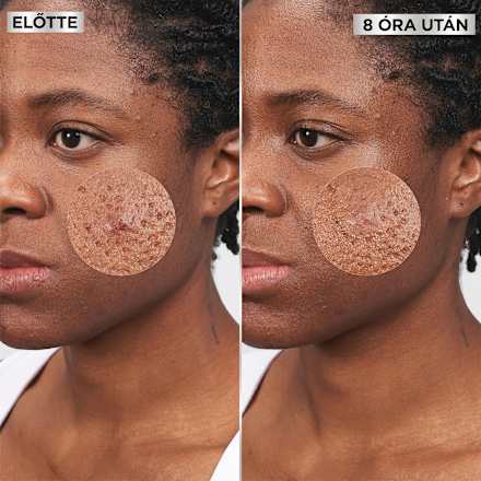 Pattanás tapasz Pimple Patch GARNIER PureActive