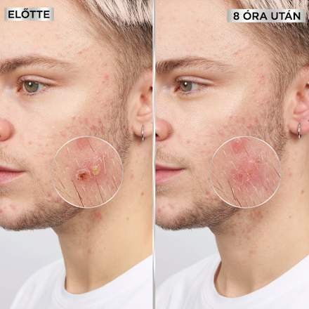 Pattanás tapasz Pimple Patch GARNIER PureActive