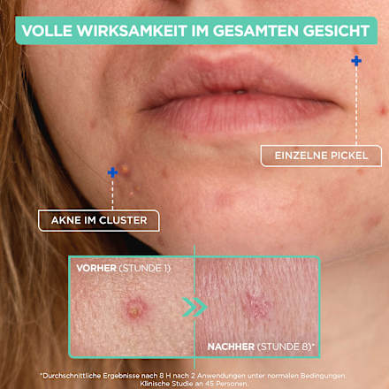 Anti Pickel Paste Mixa