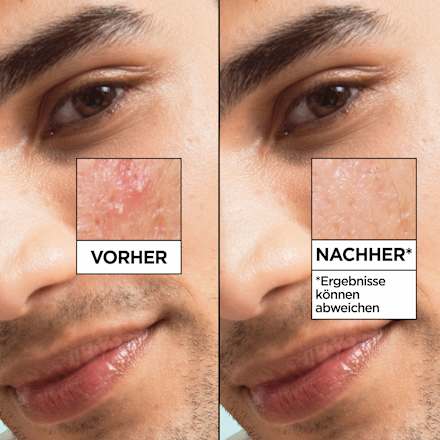 Serum Salicylic GARNIER