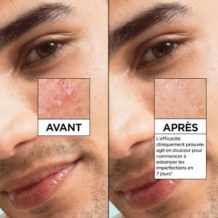 Serum Salicylic GARNIER