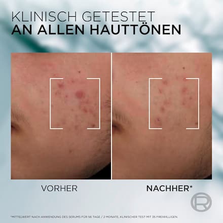 Anti-Unreinheiten Serum Derma Control L'ORÉAL PARiS MEN EXPERT