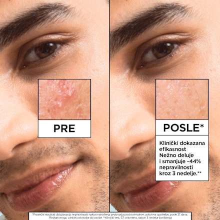 SALICYLIC serum lice  GARNIER