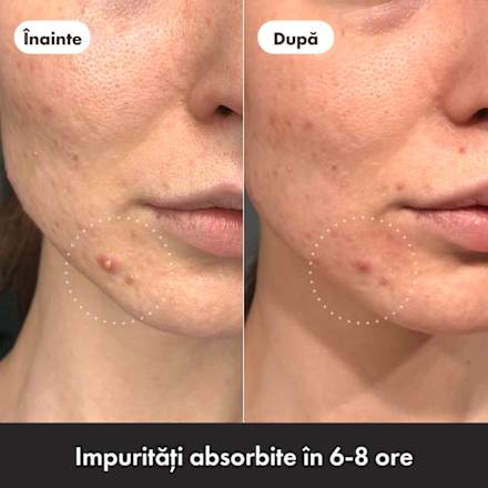 Plasturi hidrocoloidali pentru acnee duo Hero.