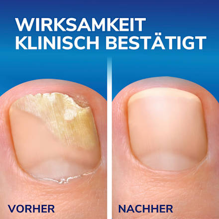 Nagelpilz Entferner Stift Scholl