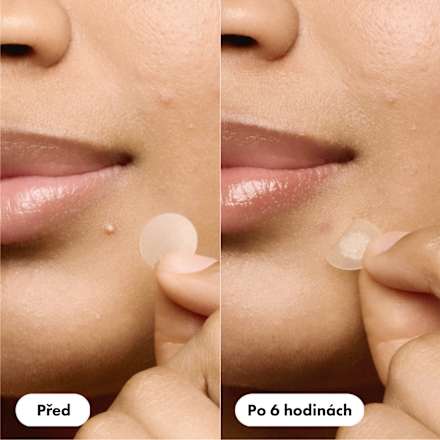 náplasti na akné Mighty Patch The ORIGINAL Hero.