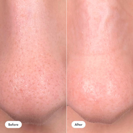 náplasti na akné Mighty Patch Nose Hero.