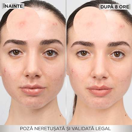 Plasturi pentru cosuri  GARNIER PureActive