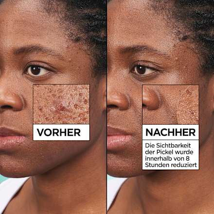 Anti Pickel Patches Invisible Garnier Skin Active