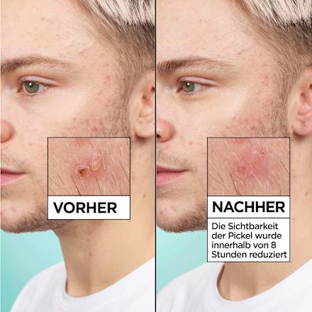 Anti Pickel Patches Invisible Garnier Skin Active