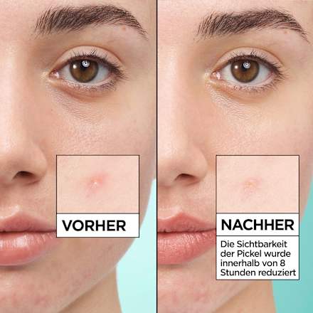 Anti Pickel Patches Invisible Garnier Skin Active