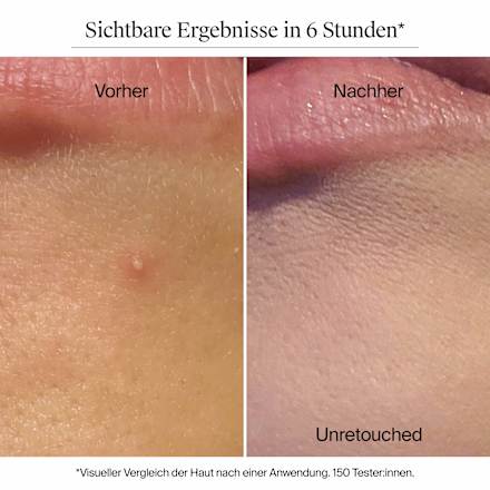 Anti-Pickel-Patches Sensitive Neutrogena